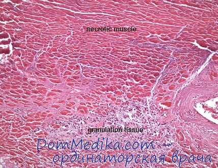 Микроскопическая картина инфаркта миокарда thumbnail