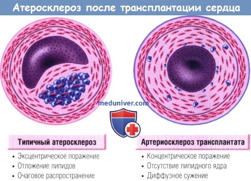 Атеросклероз бца картинки
