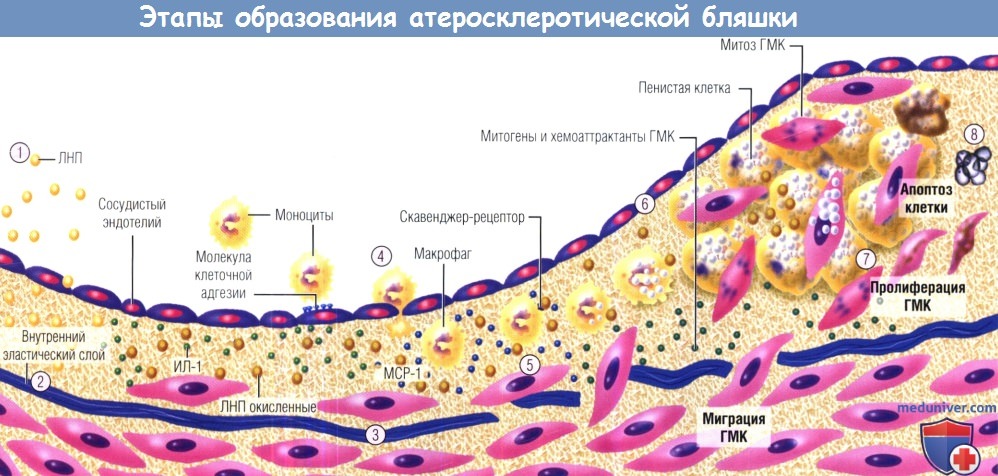 Атеросклеротическая бляшка рисунок