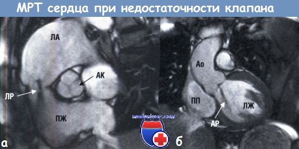 МРТ сердца при недостаточности клапана сердца