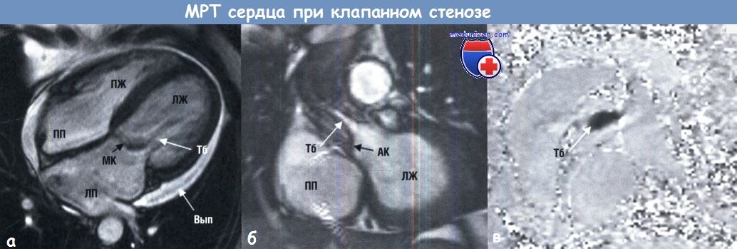 МРТ при стенозе клапана сердца