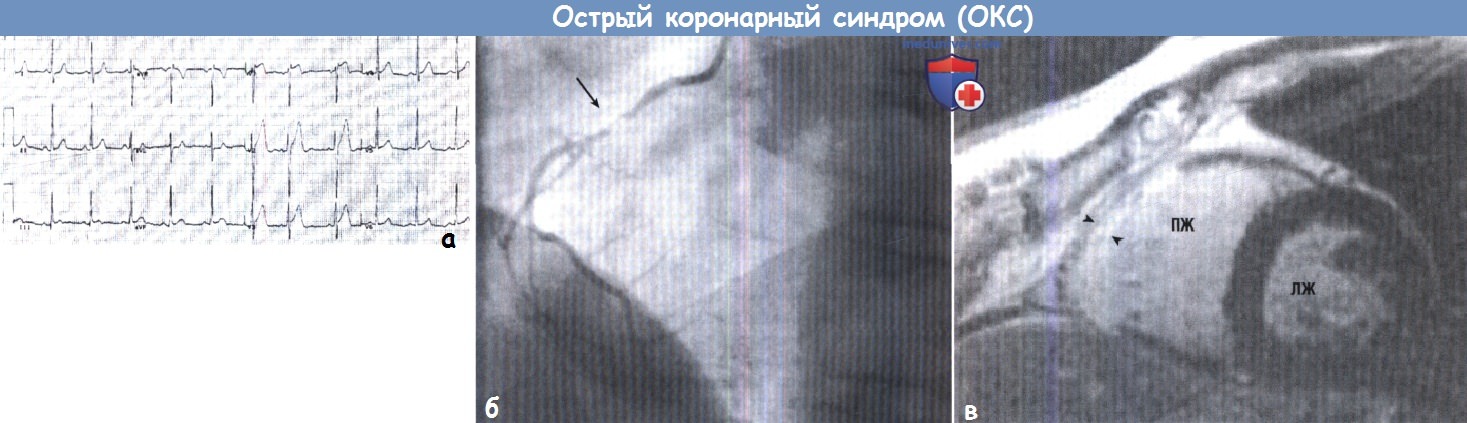 Какая артерия поражена при инфаркте миокарда thumbnail