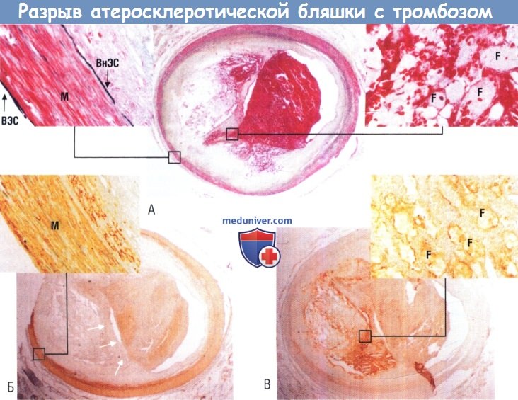 Разрыв атеросклеротической бляшки с тромбозом