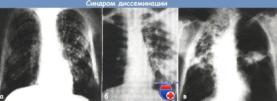 Рентгенологический синдром диссеминации при заболеваниях thumbnail