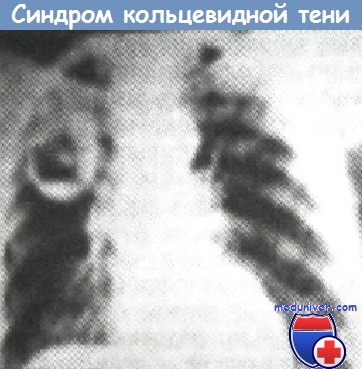 Легочные синдромы при туберкулезе легких thumbnail