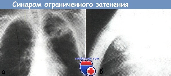 Рентгенологические синдромы при туберкулезе органов дыхания thumbnail
