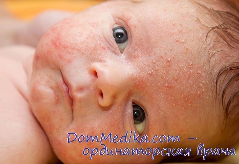 Атопический дерматит у детей фото