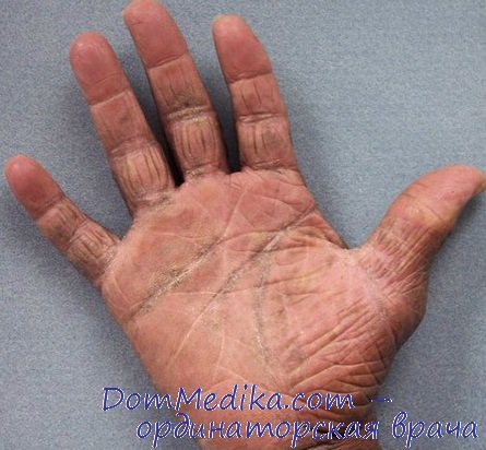 защита кожи при дерматите