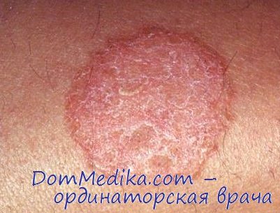 Паховая дерматофития фото у женщин