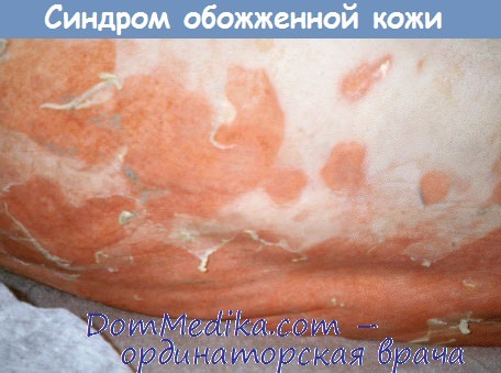 синдром обожженной кожи