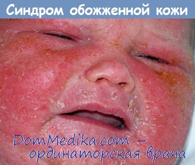 синдром обожженной кожи