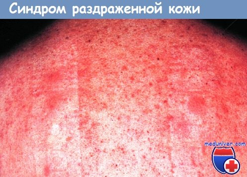 Синдром ошпаренной кожи фото