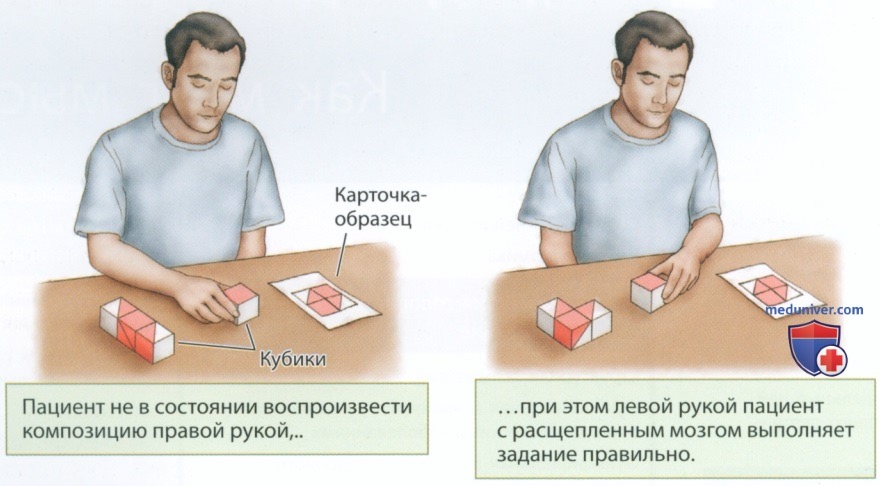 Расщепленный мозг