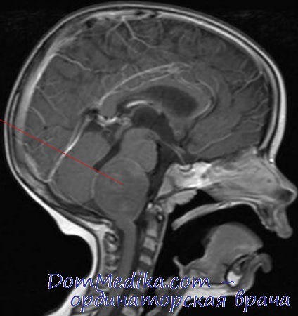 Опухоль ствола головного мозга у ребенка: причины, диагностика ...