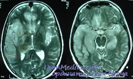 МРТ при остром рассеянном энцефаломиелите