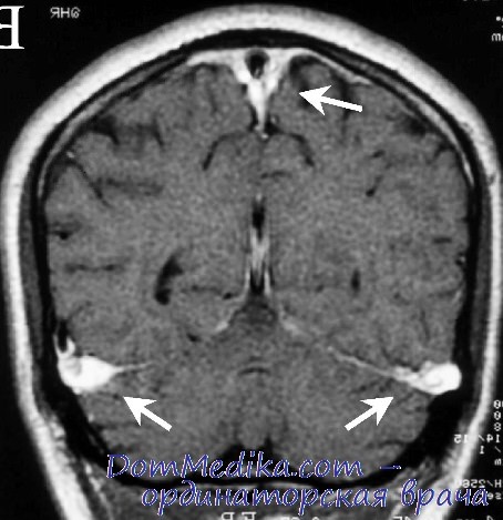 Церебрального тромбоза. Тромбоз синусов головного мозга кт. Тромбоз венозного синуса головного мозга кт. Тромбоз поперечного синуса головного мозга на кт. Тромбоз сагиттального синуса на кт.
