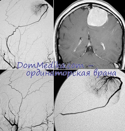 Инсульт и опухоль головного мозга дифференциальный диагноз thumbnail