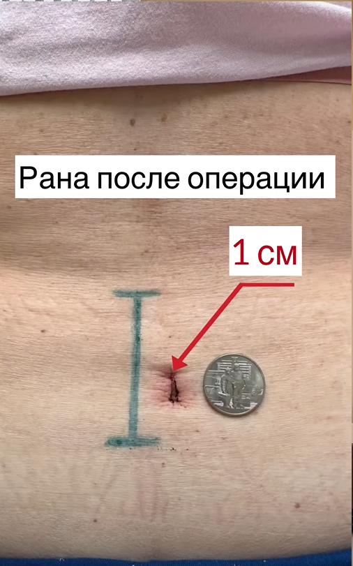 Убрали стеноз позвоночного канала за два часа — разбор клинического случая