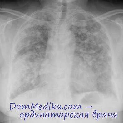 лечение поражений легких