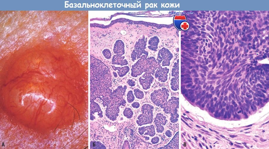 Базальноклеточная карцинома фото