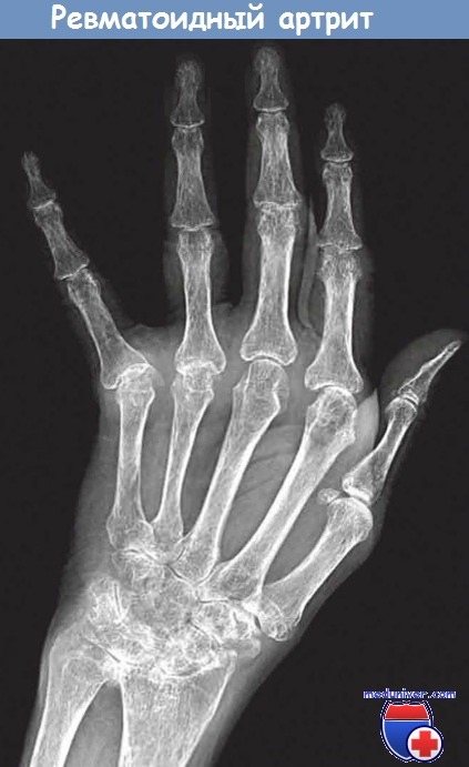Рентгенография кисти при ревматоидном артрите