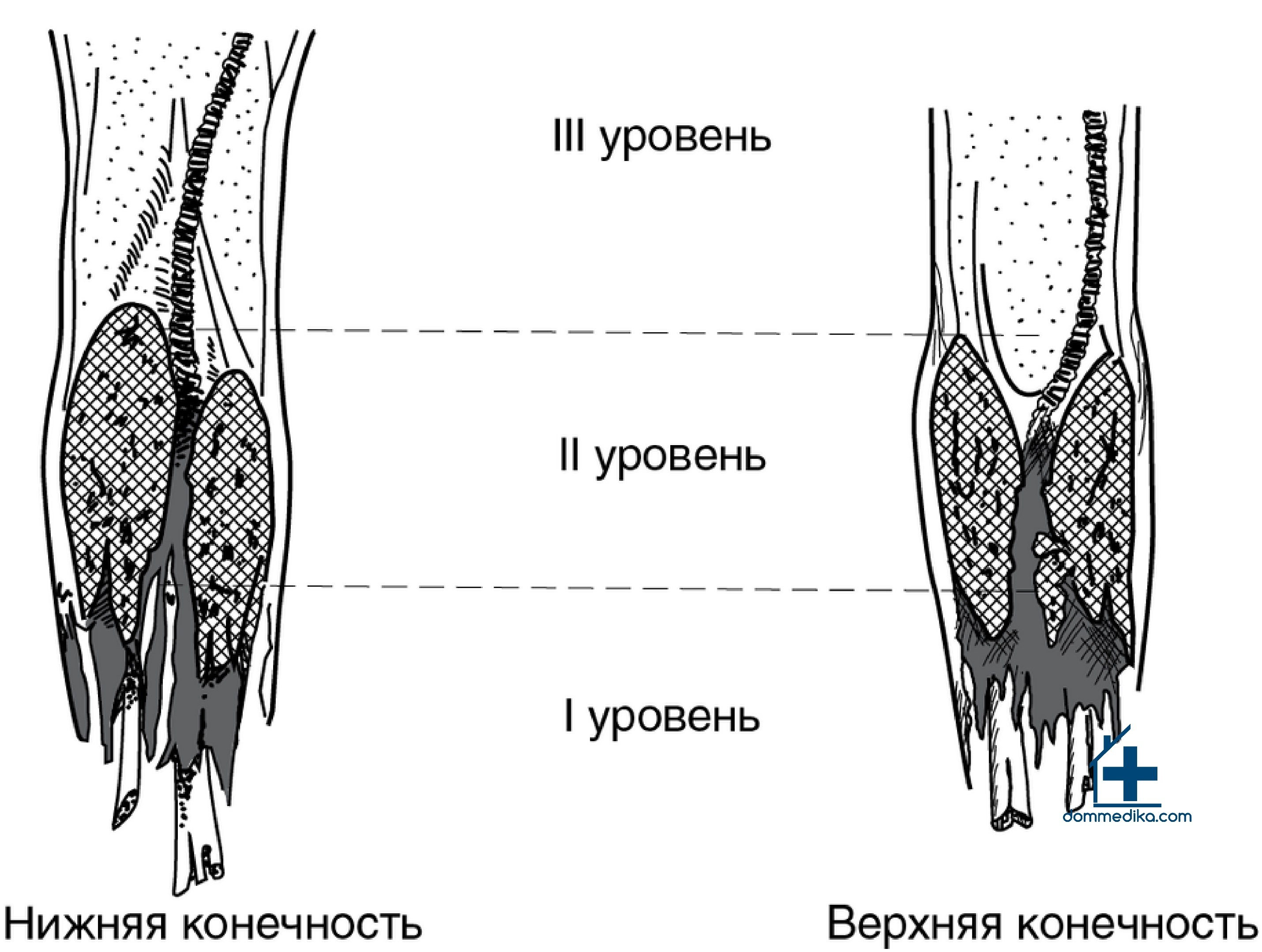 Взрывные поражения