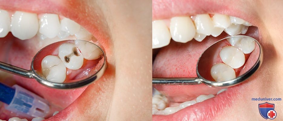 Восстановление зуба пломбой