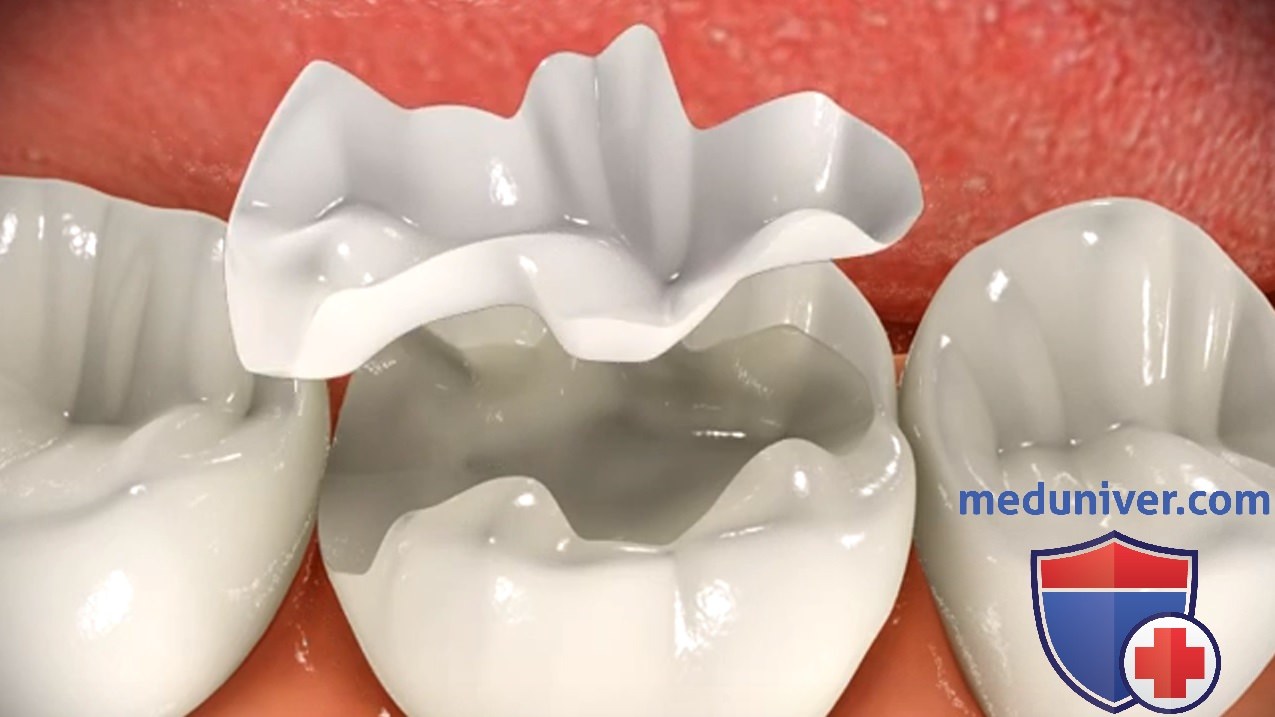 Восстановление зуба керамической вкладкой