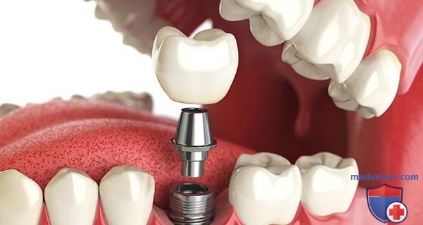 Восстановление зуба имплантом и коронкой