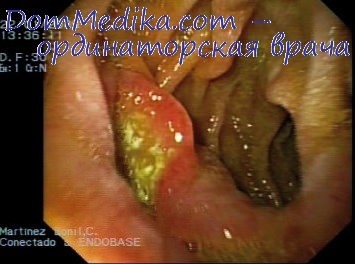Эндоскопическая картина при язвенной болезни желудка thumbnail